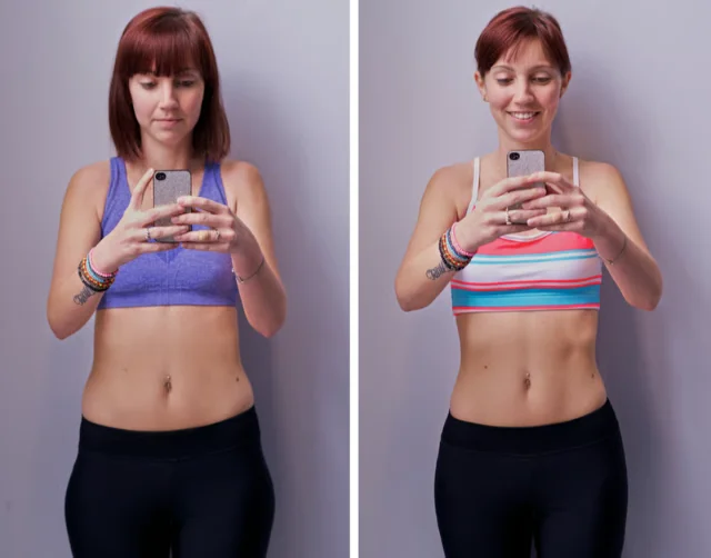 Before and After Biostimulator Results