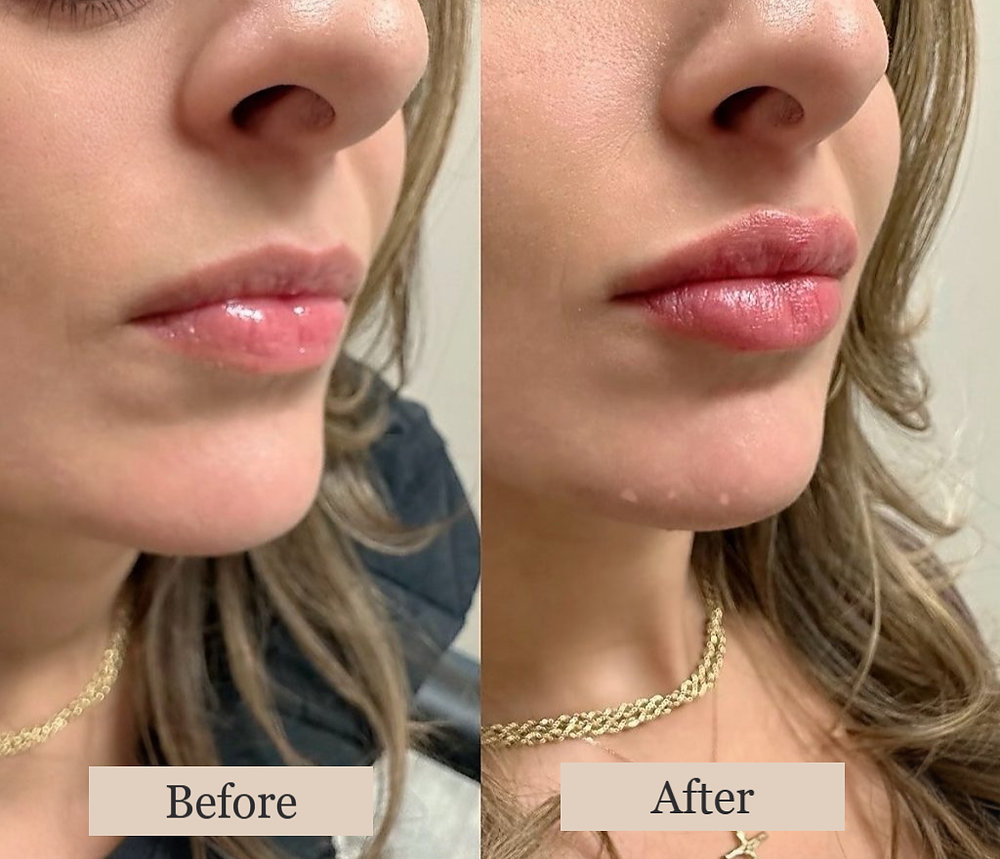 Before & After Lip Filler Results