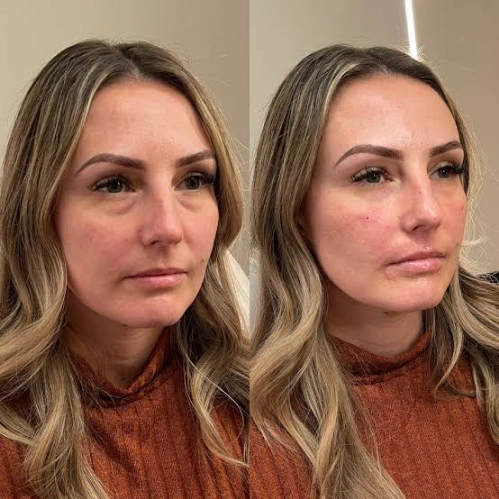 Before & After Under-Eye Filler Results